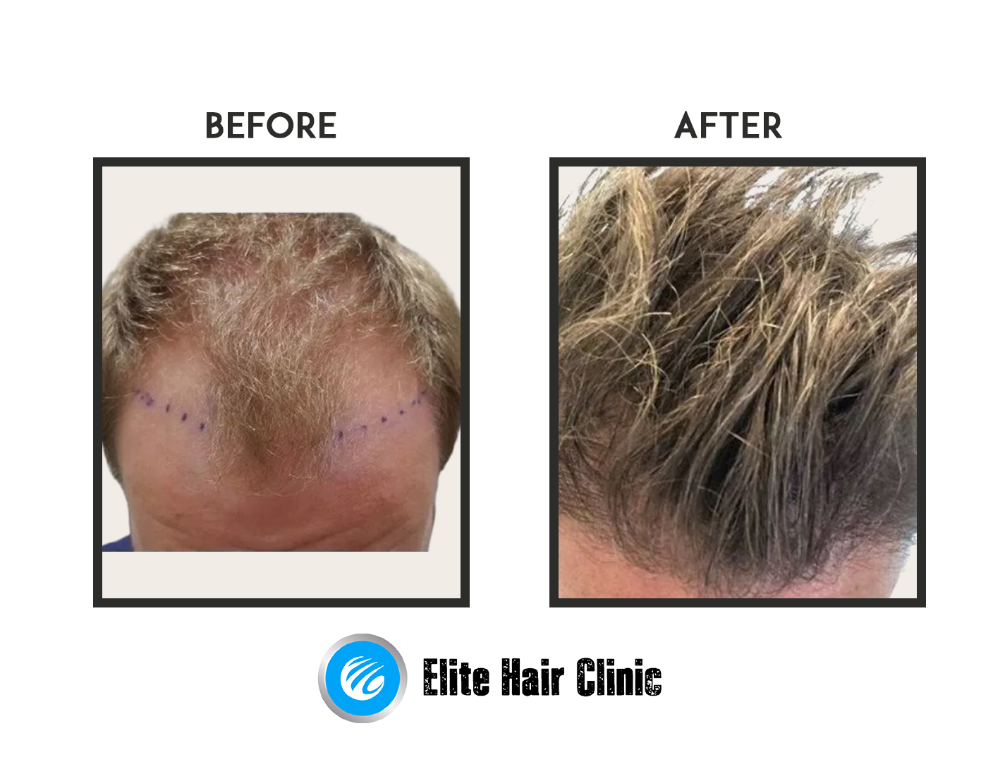 hair transplant Sydney before and after