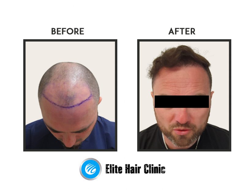 Before And After Fue Hair Elite Hair Clinic Sydney Hair Transplant