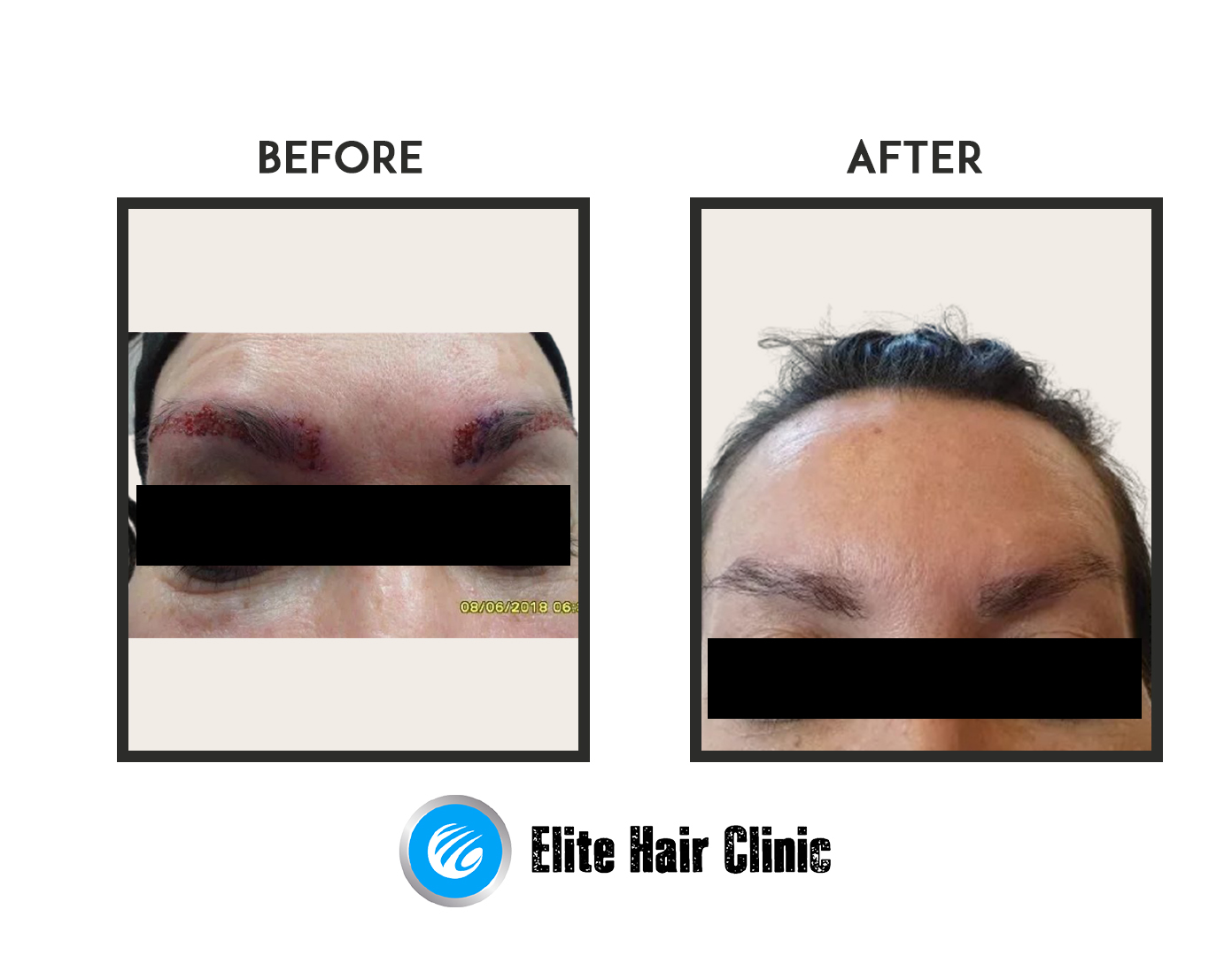 hair transplant in Sydney Before and After