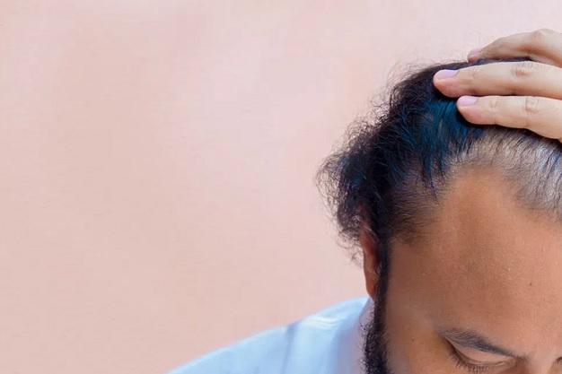 Causes and Treatment for Hair Loss