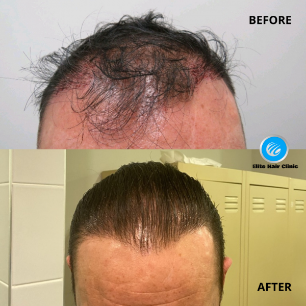 Before and After Hair Transplant in Sydney | Elite Hair Clinic Sydney