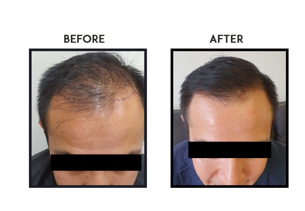 Before and After Hair Transplant in Sydney | Elite Hair Clinic Sydney Before and After Hair Transplant in Sydney | Elite Hair Clinic Sydney