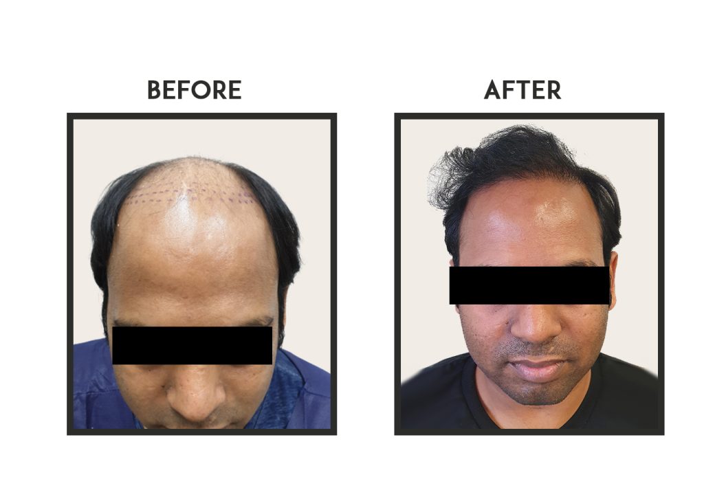 Before and After Hair Transplant in Sydney | Elite Hair Clinic Sydney
